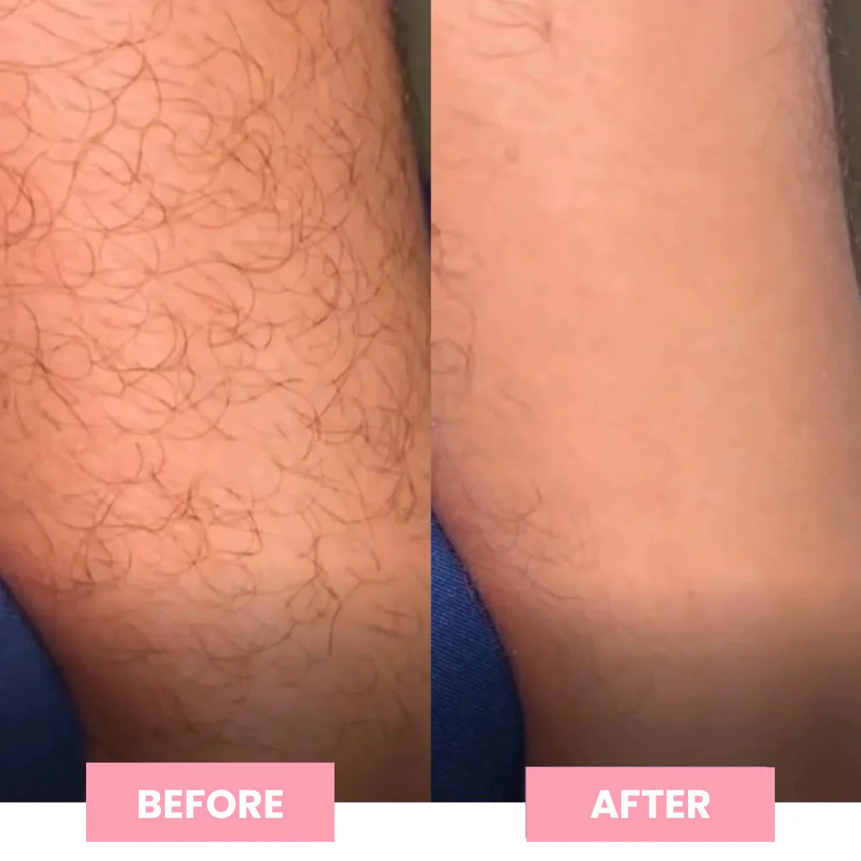 Épilateur Nano-Cristaux ✨ La Douceur Instantanée pour une Peau Parfaite